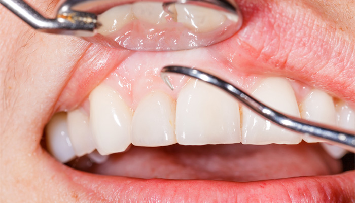 歯槽膿漏、歯周病が口臭の原因